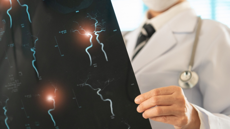 Mi okozza ténylegesen a stroke-ot és a szívinfarktust? – Csak így lehet megelőzni! 4.